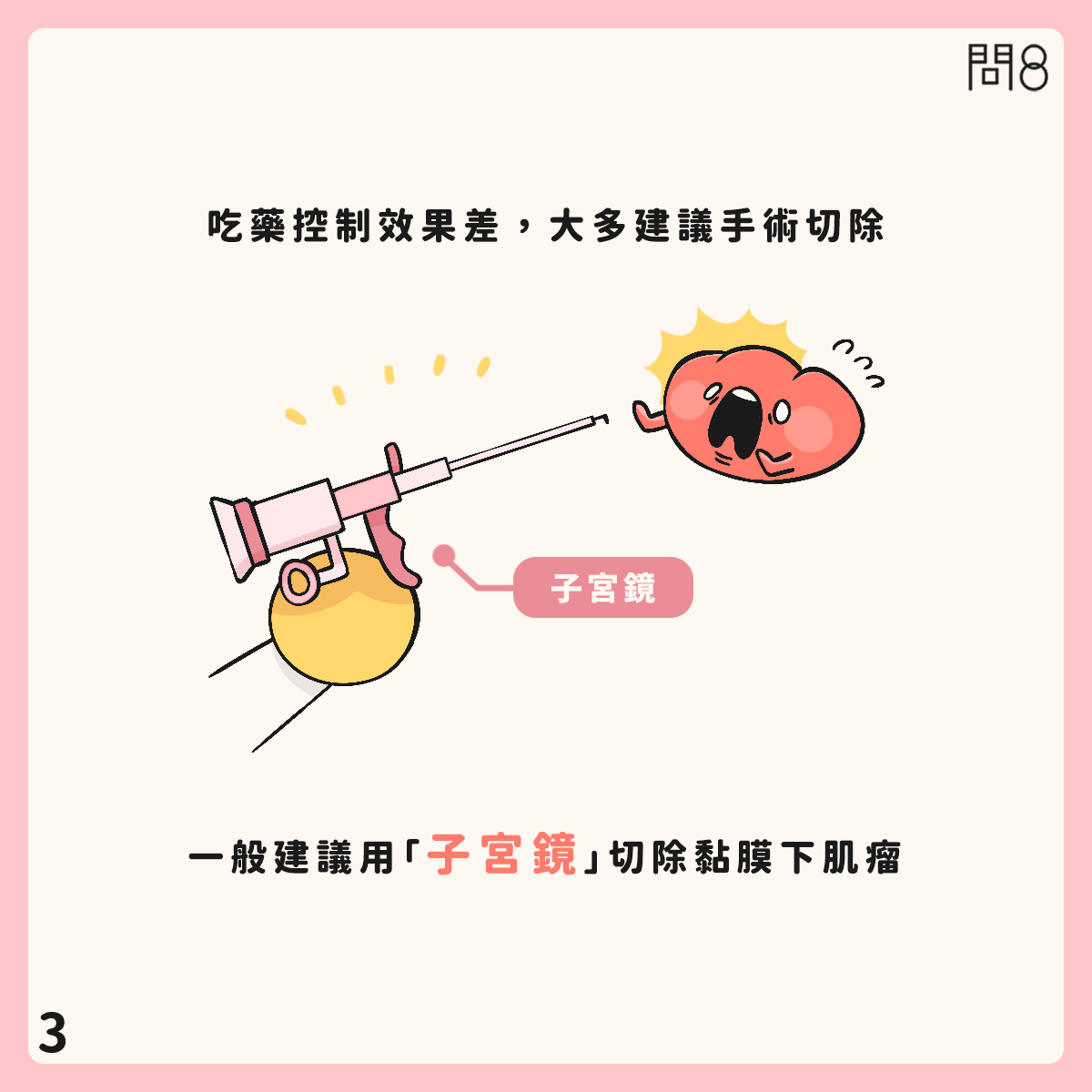 粘膜下肌瘤的治療原則—多波光雷射、電燒、冷刀如何選擇?
